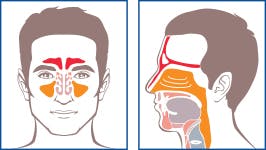 Difference Between Allergies Sinusitis Flonase
