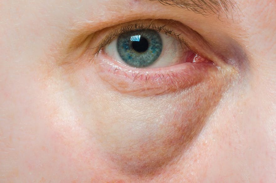 swollen-eye swollen-eye