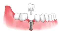 dental implant support icon