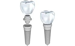 Dental implant icon