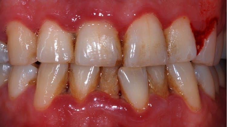 Ursachen Von Zahnfleischerkrankungen Und Parodontitis Chlorhexamed
