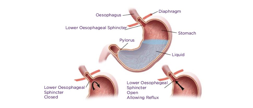 970x416 Nexium Portal Images 4 Image of stomach showing cause of heartburn