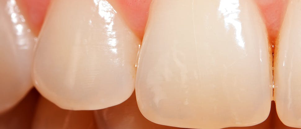 Enamel worn teeth