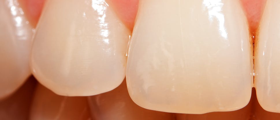 Enamel worn teeth