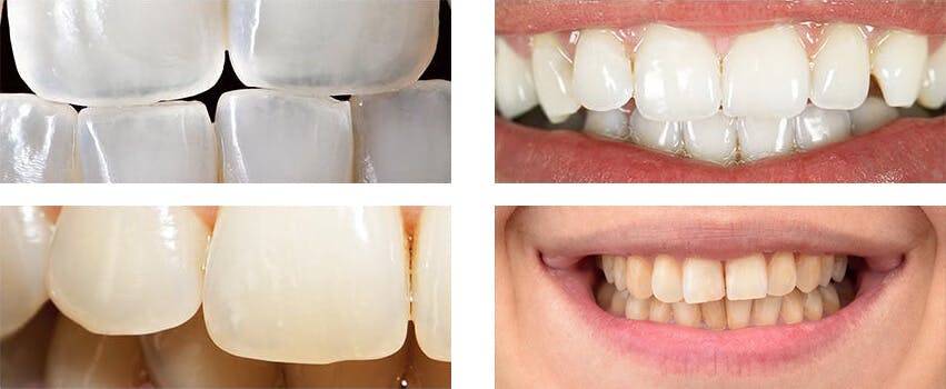 severe translucent teeth