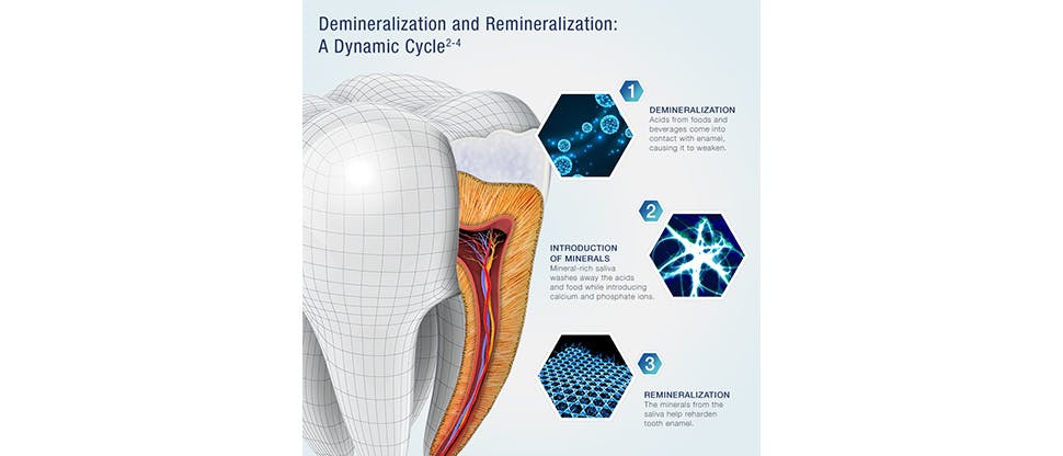 Demineralization-and-Reminerlisation