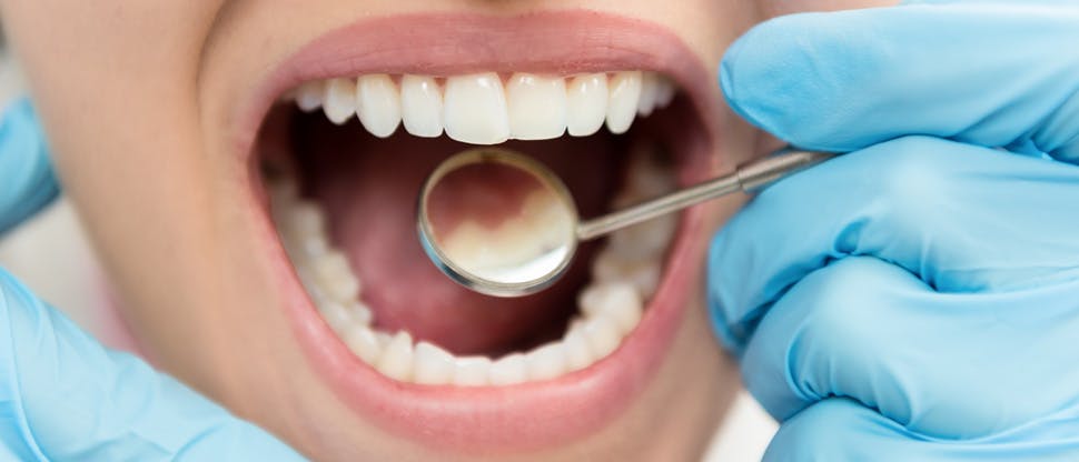 656608576 Enamel Erosion with patient