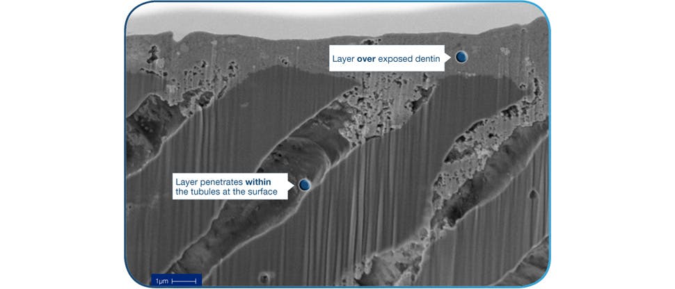 in vitro X section SEM image showing occlusive layer over exposed dentin