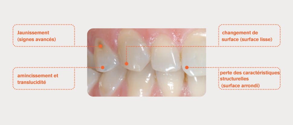 Dents avec émail usé