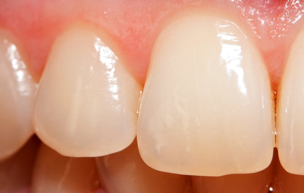 Enamel worn teeth