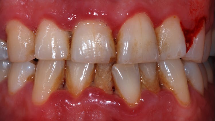 炎 治療 歯肉 歯肉炎の治療と予防