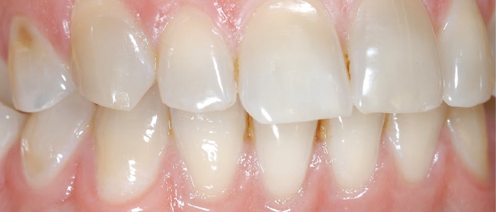 Desgaste do esmalte