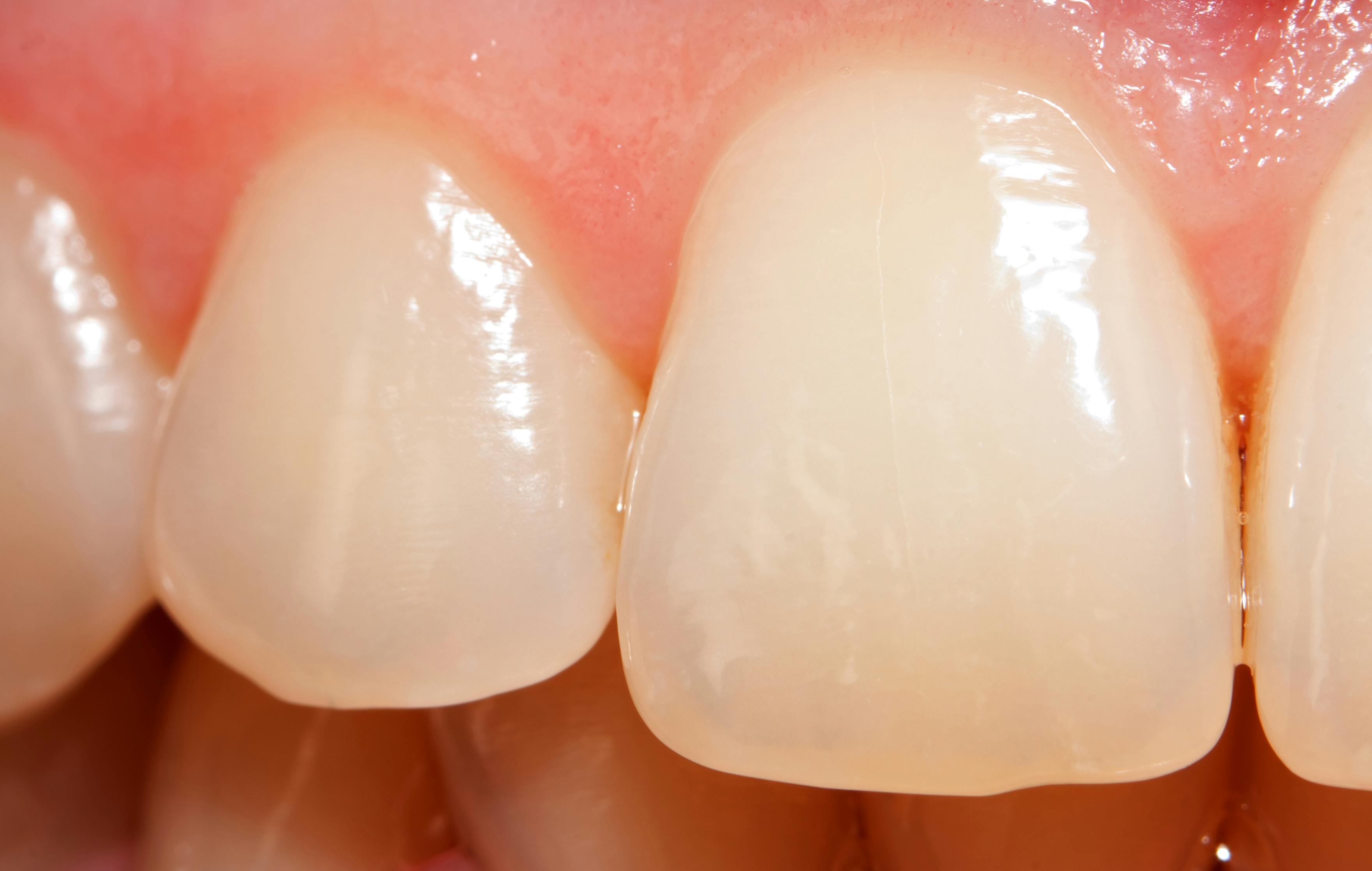 111969202 Dentes com desgaste do esmate
