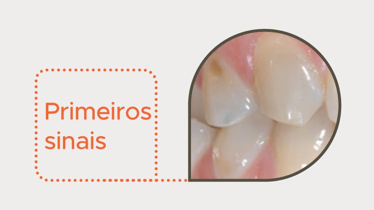 Primeiros sinais de desgaste do esmalte
