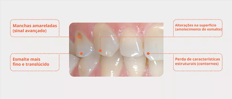 Dentes com desgaste do esmalte