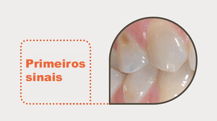 Primeiros sinais de desgaste do esmalte
