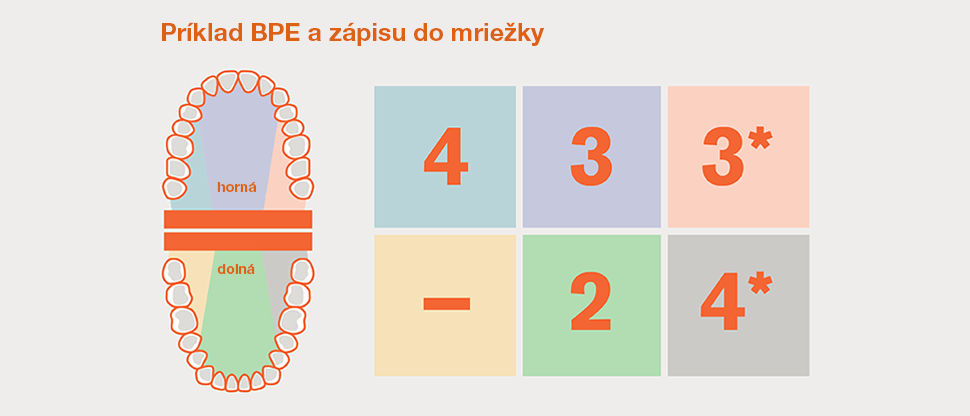 BPE rozdelenie chrupu do sextantov a príklad mriežky