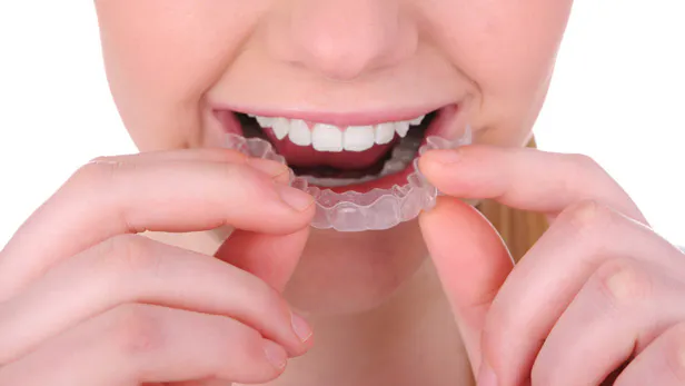 歯科矯正中 リテーナーによる出血 歯周病予防の歯磨き粉カムテクト