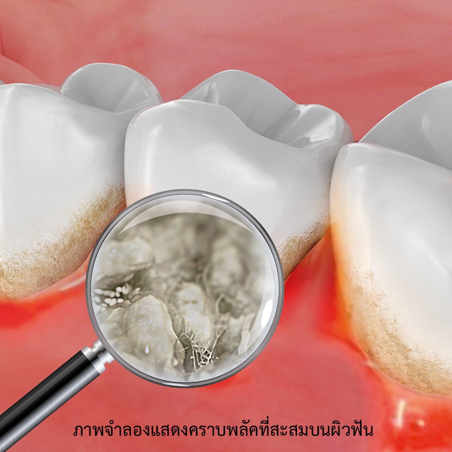 ภาพจำลองแสดงคราบพลัคที่สะสมบนผิวฟัน ทำให้เกิดกลิ่นปาก