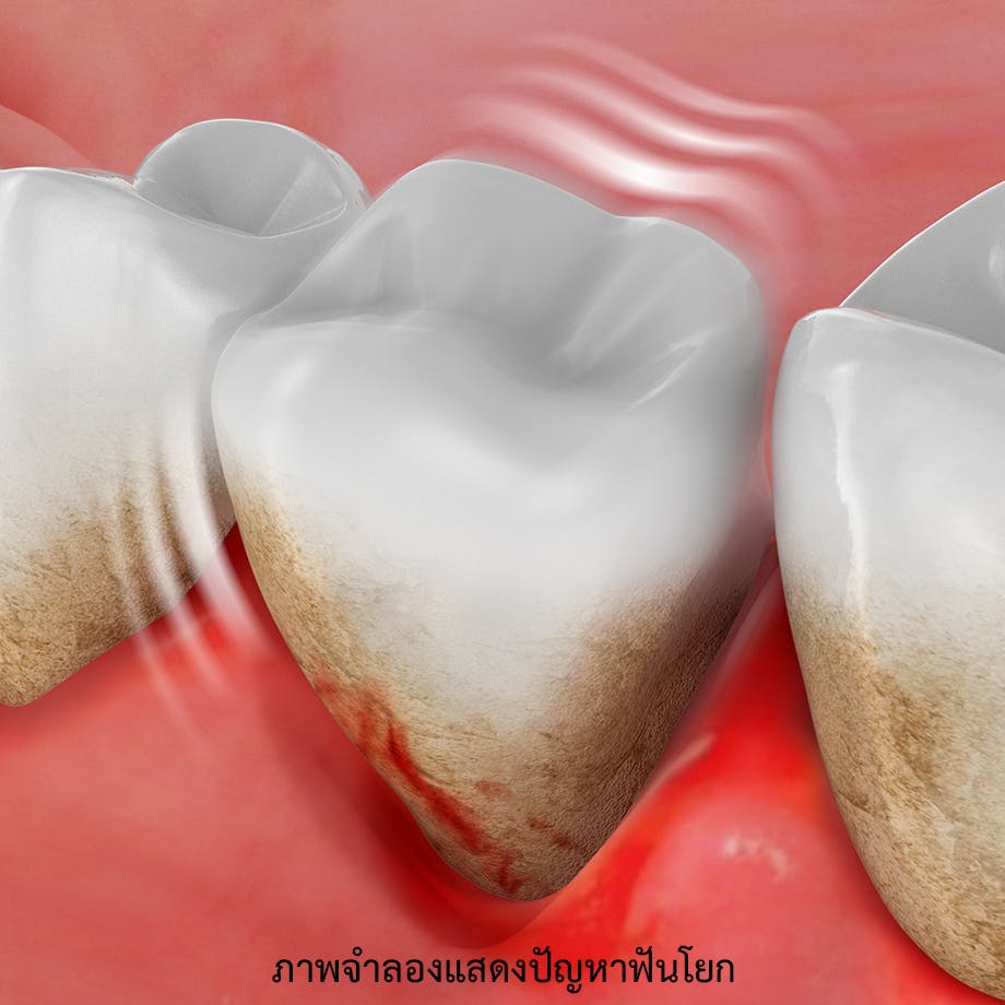 ภาพจำลองแสดงปัญหาฟันโยก และการสูญเสียฟัน