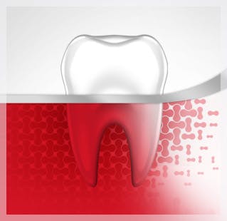 Stages of Gum Disease Stages of Gum Disease