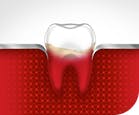 Inflamed Gums Bleeding Gums parodontax Inflamed Gums Bleeding Gums parodontax