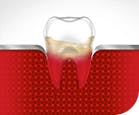 Bleeding Gums Tooth Gum Disease Stage 3 parodontax Bleeding Gums Tooth Gum Disease Stage 3 parodontax