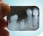 X-Ray Teeth Gum Disease parodontax X-Ray Teeth Gum Disease parodontax