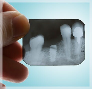 X-Ray Teeth Gum Disease parodontax X-Ray Teeth Gum Disease parodontax