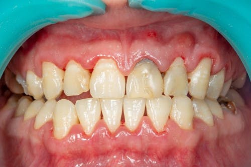 Bared teeth and gums afflicted with Periodontitis Close-up of bared teeth and gums afflicted with periodontitis