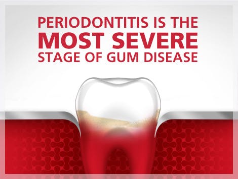 Periodontitis - the most severe stage of gum disease periodontitis is the most severe stage of gum disease