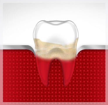 Bleeding Gums Tooth Gum Disease Stage 3 parodontax Bleeding Gums Tooth Gum Disease Stage 3 parodontax