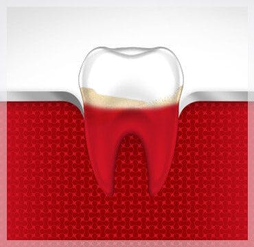 Inflamed Gums Bleeding Gums parodontax Inflamed Gums Bleeding Gums parodontax