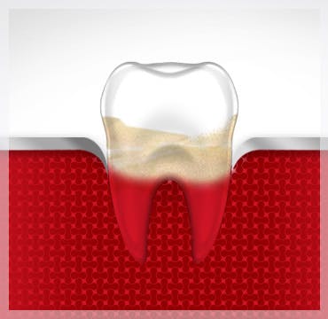 Bleeding Gums Tooth Gum Disease Stage 3 parodontax Bleeding Gums Tooth Gum Disease Stage 3 parodontax
