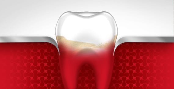 Bleeding Gums Tooth Gum Disease Stage 2 parodontax
