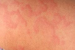 Hives on skin Hives on skin