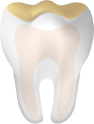 Dent présentant de l'usure par acide Dent présentant de l'usure par acide