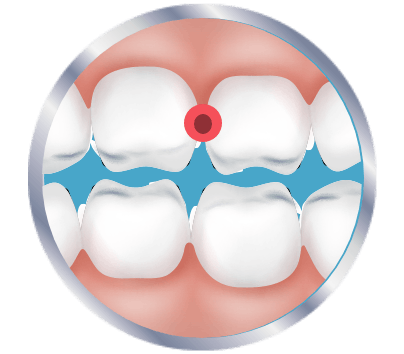 Is It A Cavity Or Sensitive Teeth Sensodyne