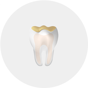 Cut away view of a tooth highlighing acid erosion