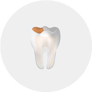 Cut away view of a tooth highlighing a cavity
