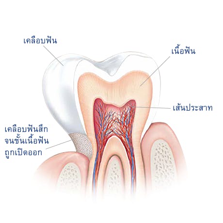 อะไรคือสาเหตุของการเสียวฟัน? อะไรคือสาเหตุของการเสียวฟัน?