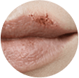 Ulcer Stage ulcer stage