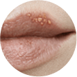Blister Stage blister stage