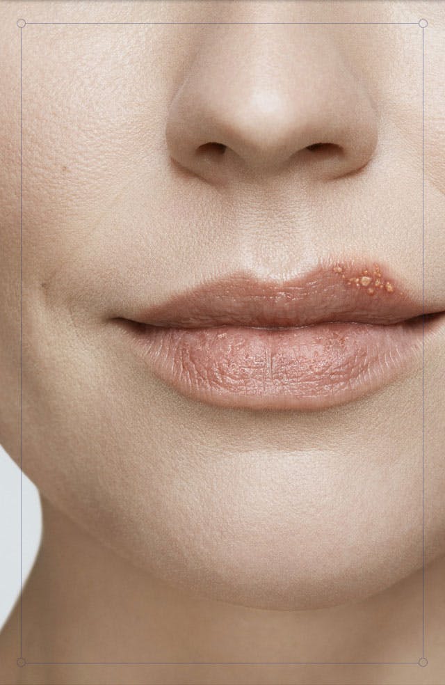 Blister stage face Blister stage face