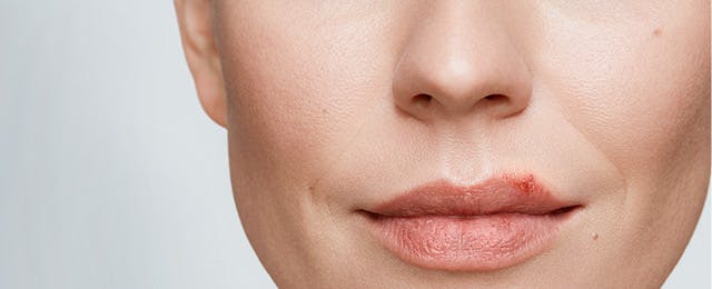 What Are Cold Sores Causes Symptoms More Abreva