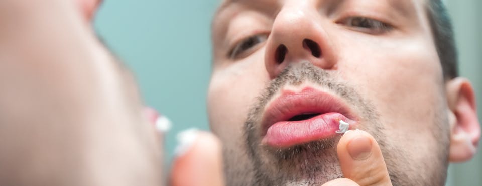 Man putting white ointment on cold sore Man putting white ointment on cold sore