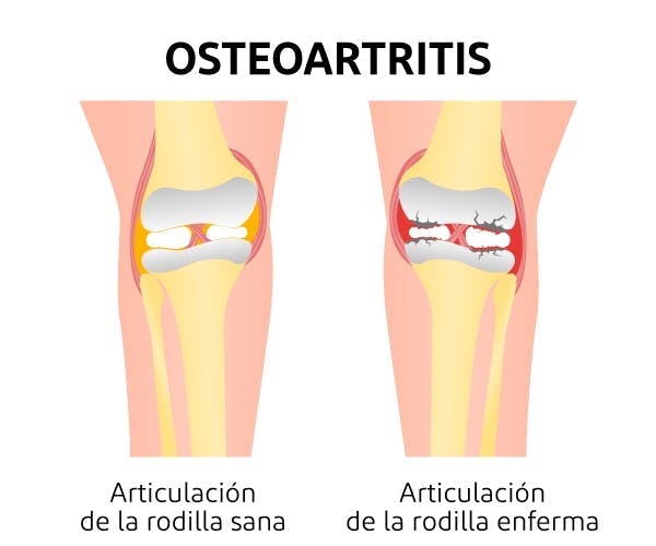 osteoartritis degenerativa
