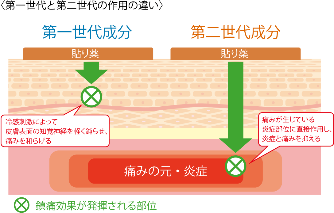 私のつらい痛みに合う外用消炎鎮痛剤の成分は何ですか