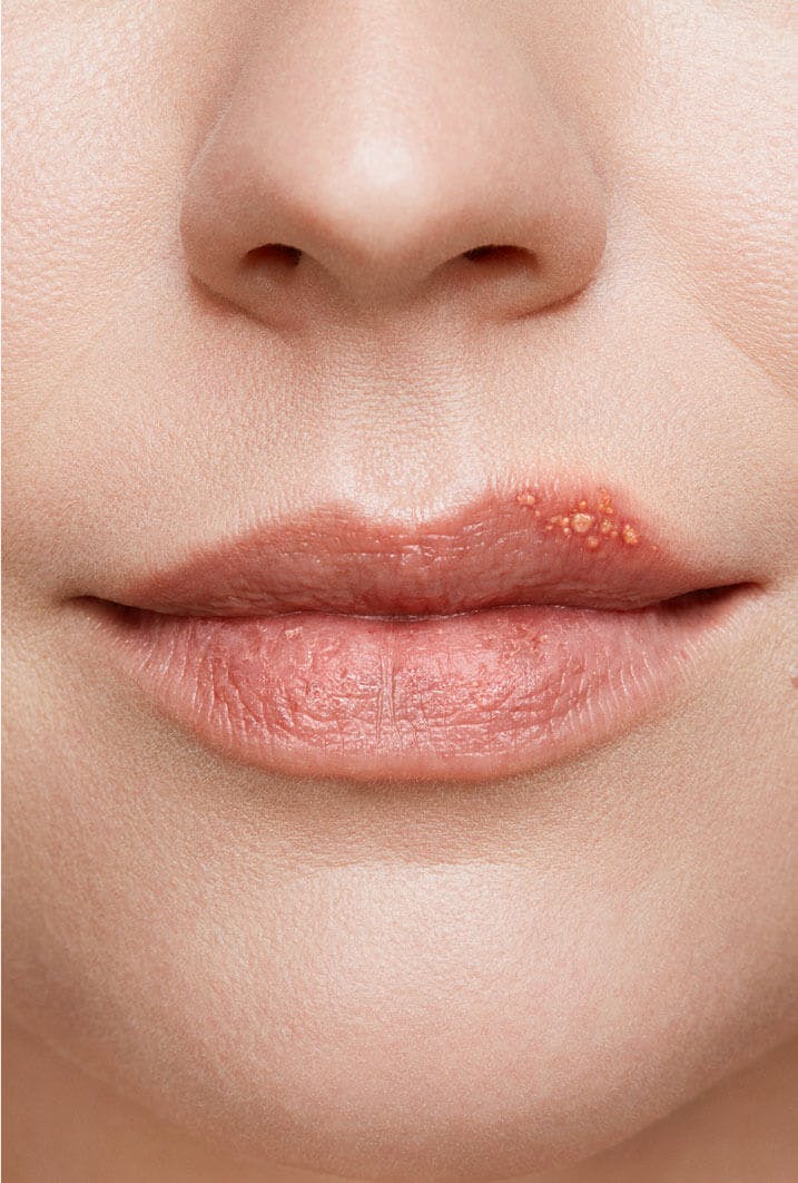 Cold Sore Healing Stages With Pictures Zovirax Au