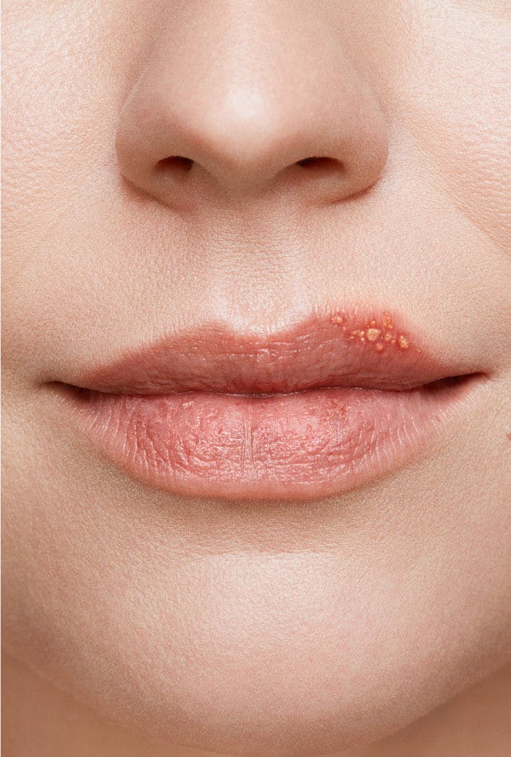 cold-sore-healing-stages-with-pictures-zovirax-au